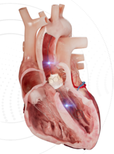 Making Intravascular Diagnosis and Treatment More Accurate and Faster: Intelligent Guidewire Design (图1)