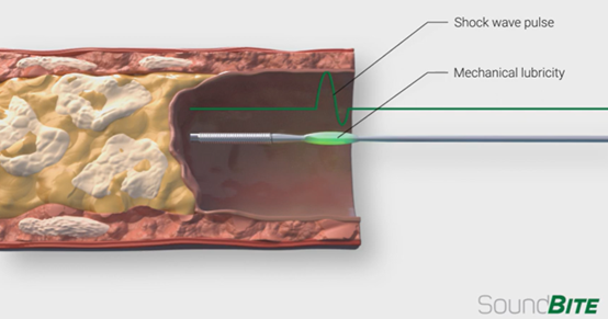 Making Intravascular Diagnosis and Treatment More Accurate and Faster: Intelligent Guidewire Design (图2)